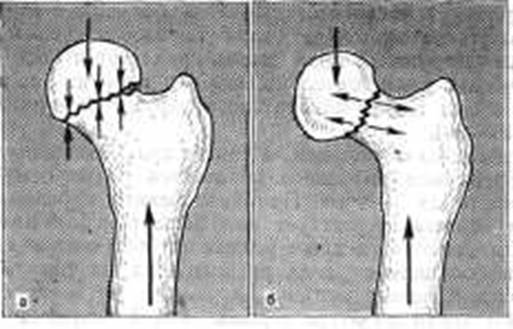 Абдукционные (вальгусные) переломы шейки бедра
