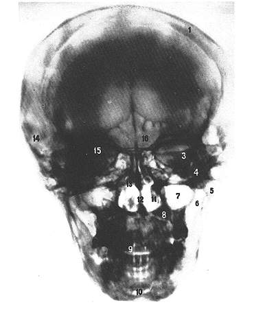 череп ренгенограмма прямая